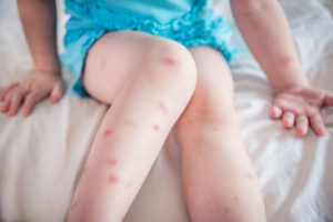 A child sits on a bed while appearing to had bed bug bites on her legs.